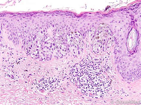 pathology outlines melanoma in situ